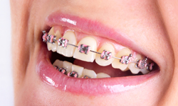 Types of Braces - Dr. Carla Capozzi Orthodontics